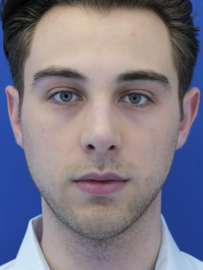 Tension Tip Projection after photo. Individual results may vary.