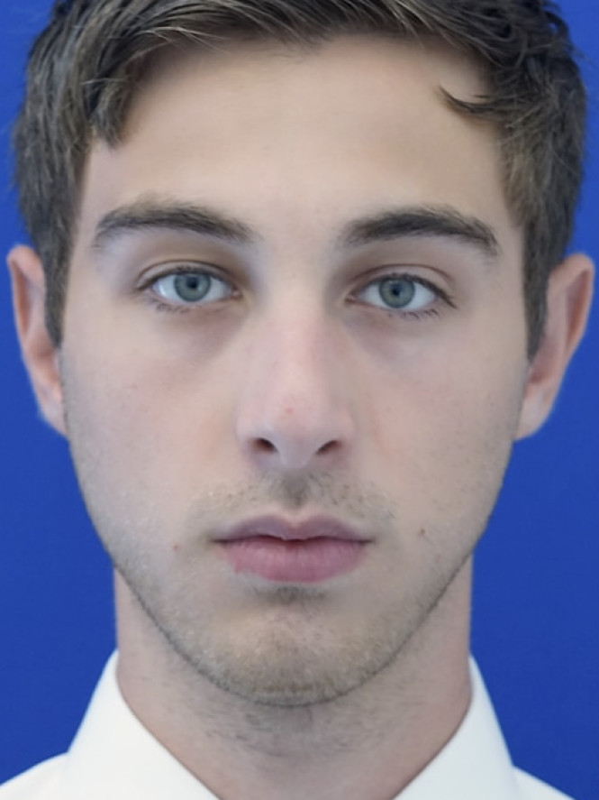 Tension Tip Projection before photo. Individual results may vary.