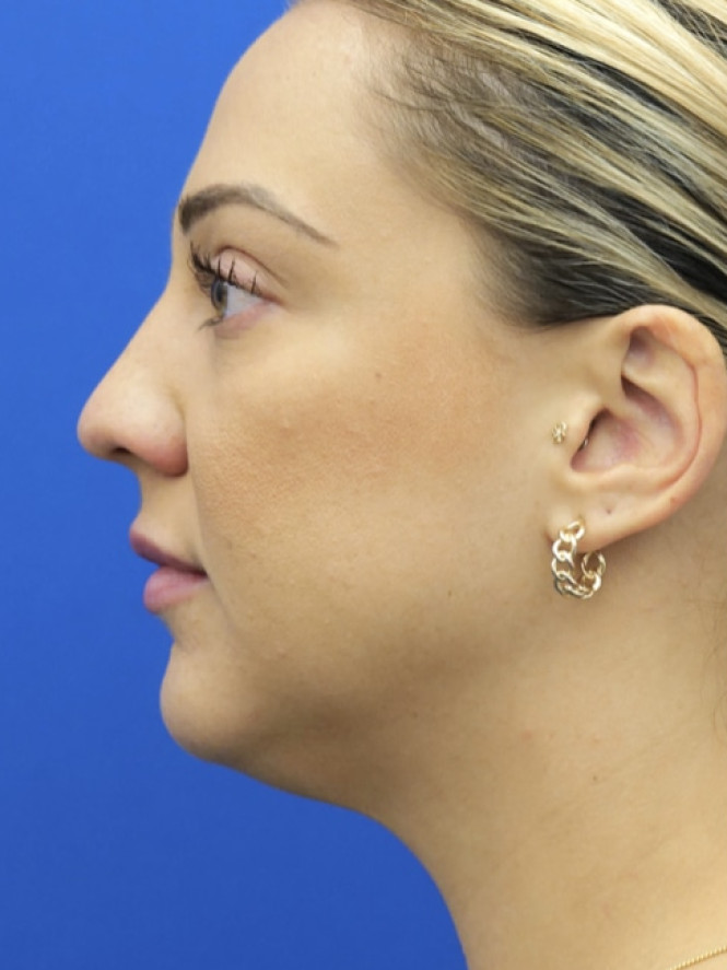 Lower Facial Rejuvenation before photo. Individual results may vary.