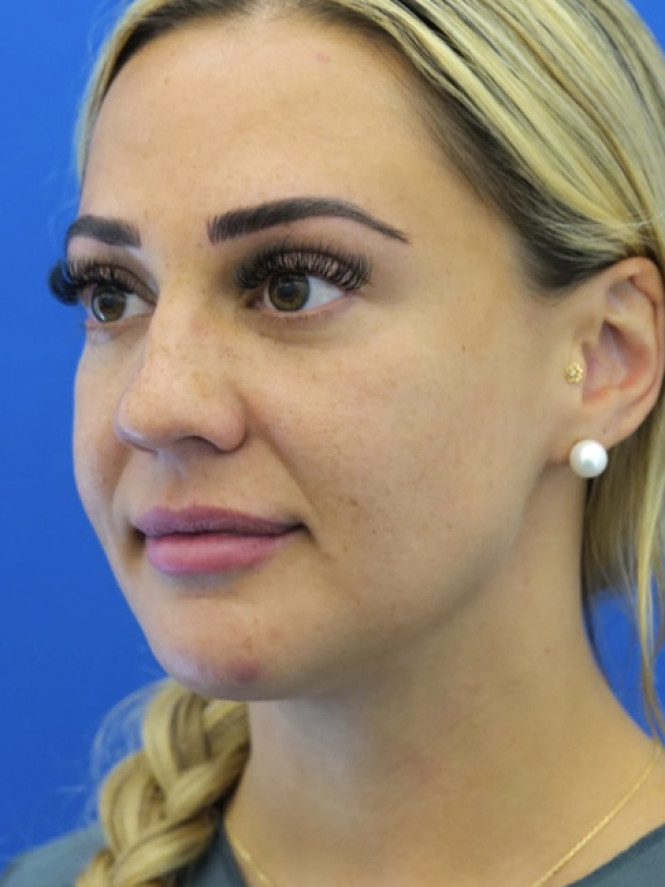 Lower Facial Rejuvenation after photo. Individual results may vary.