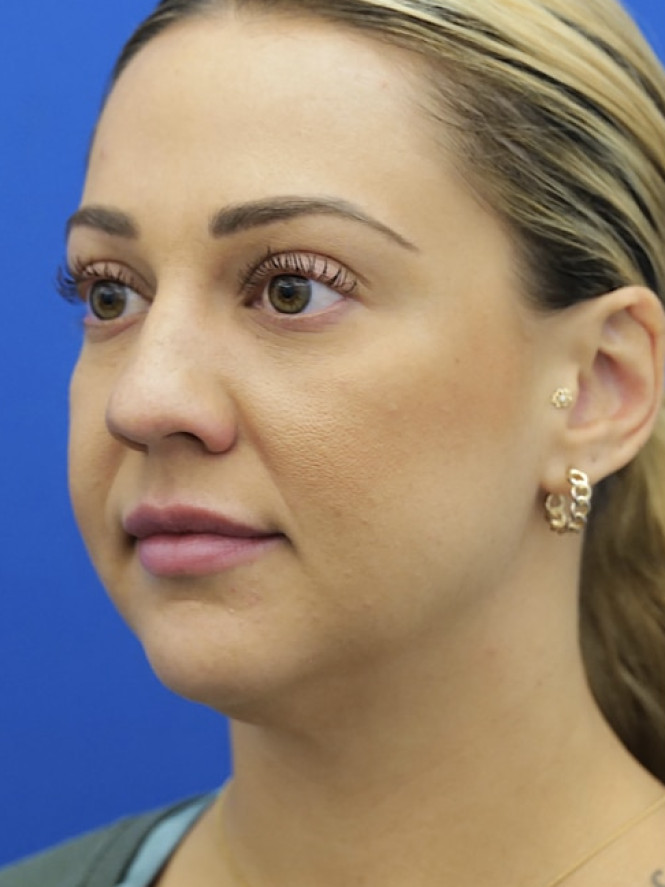 Lower Facial Rejuvenation before photo. Individual results may vary.