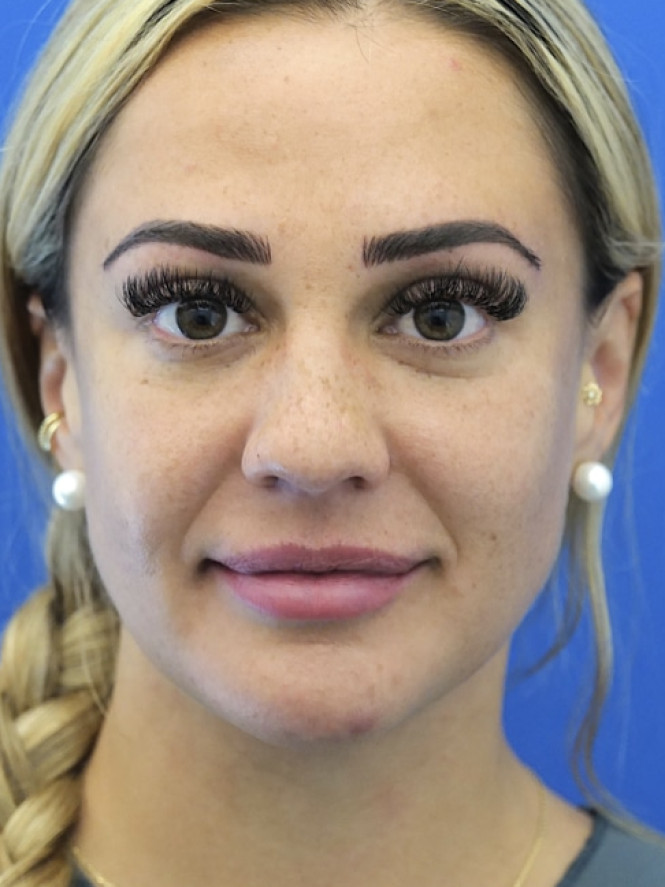Lower Facial Rejuvenation after photo. Individual results may vary.