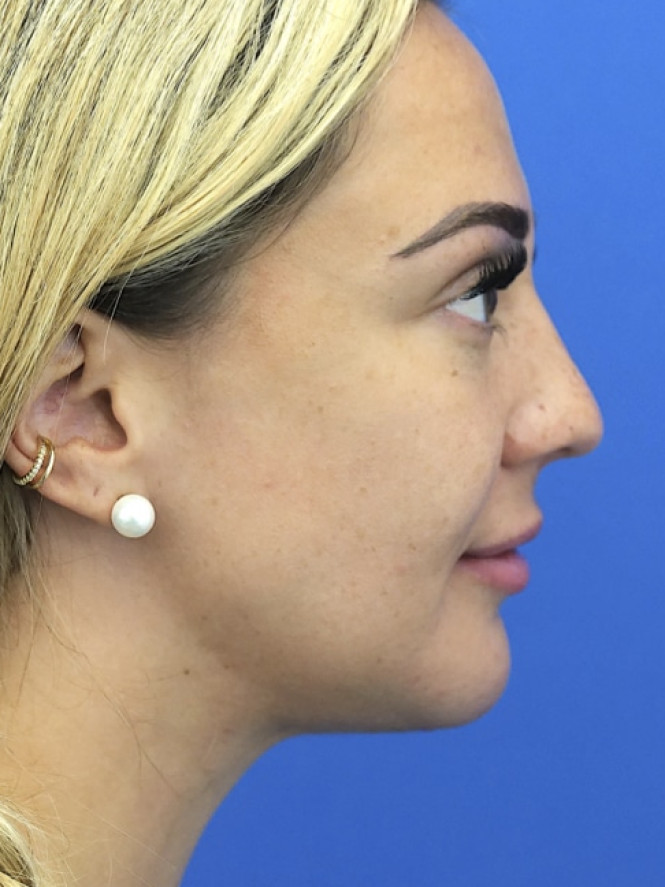 Lower Facial Rejuvenation after photo. Individual results may vary.