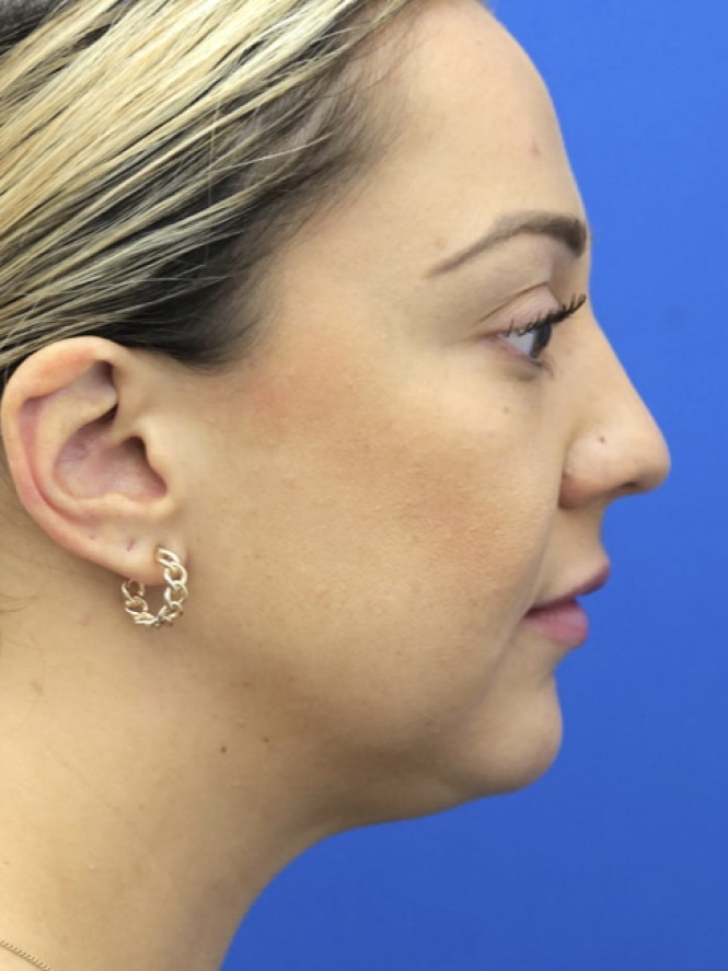 Lower Facial Rejuvenation before photo. Individual results may vary.