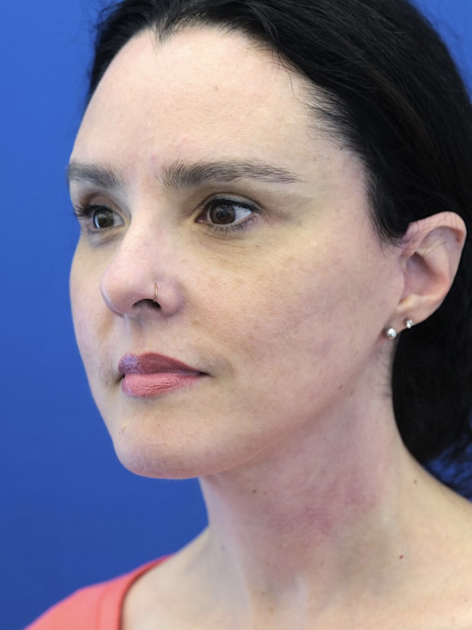 Awesome Jawline after photo. Individual results may vary.