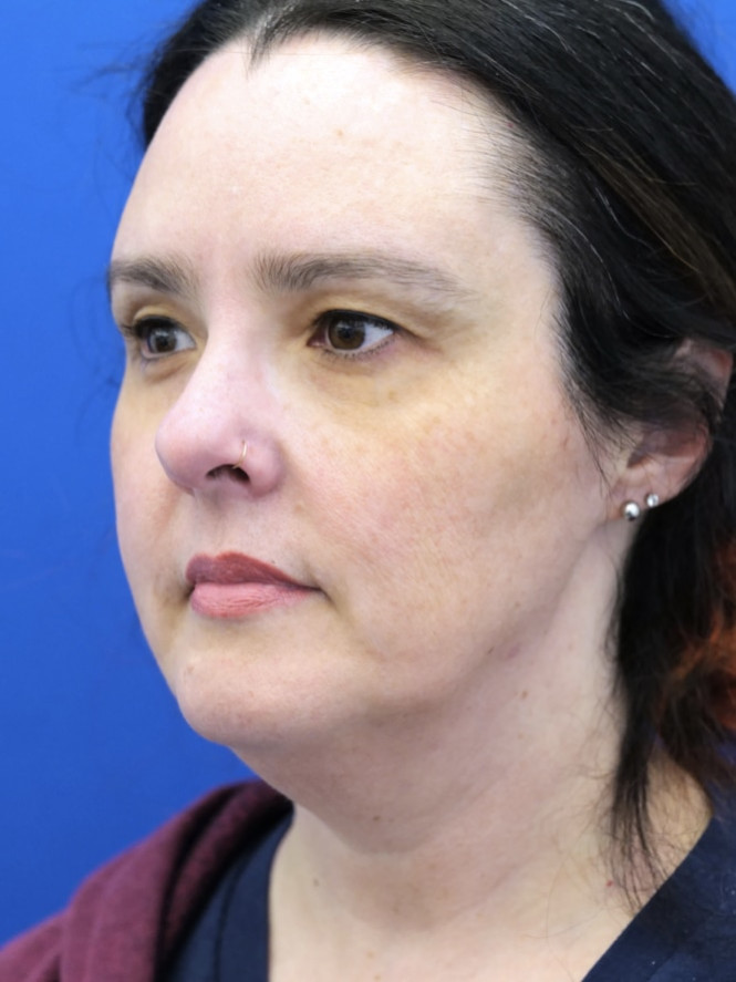 Awesome Jawline before photo. Individual results may vary.