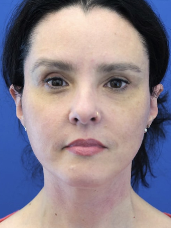Awesome Jawline after photo. Individual results may vary.
