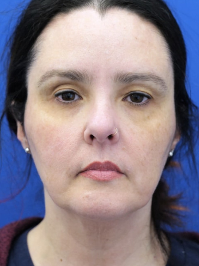 Awesome Jawline before photo. Individual results may vary.
