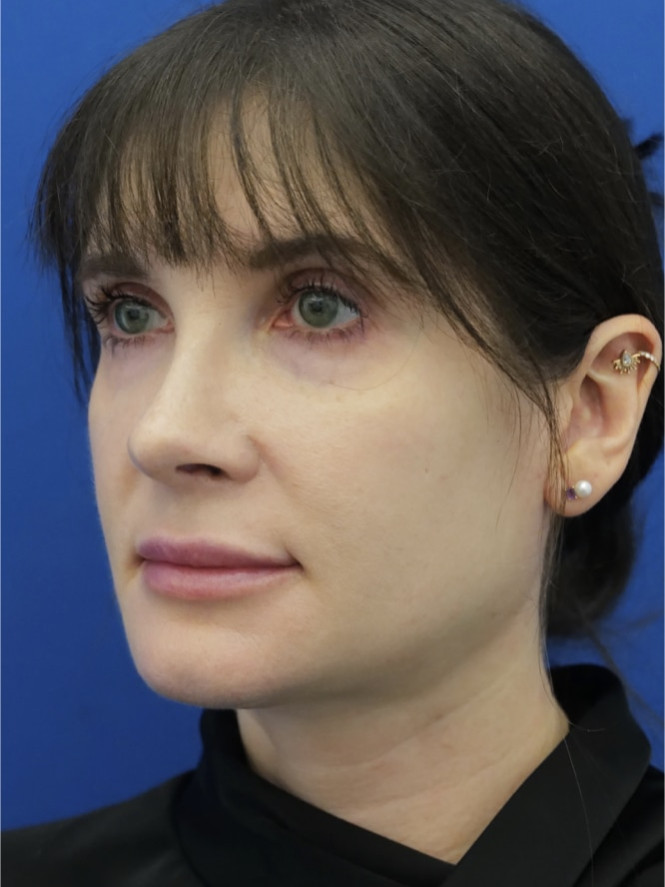 Preserving Tip Surface Aesthetics after photo. Individual results may vary.