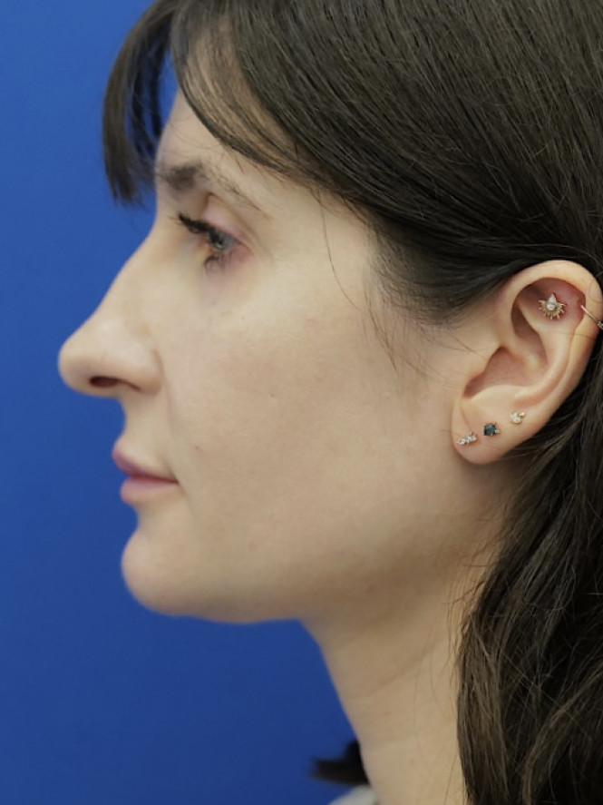 Preserving Tip Surface Aesthetics before photo. Individual results may vary.