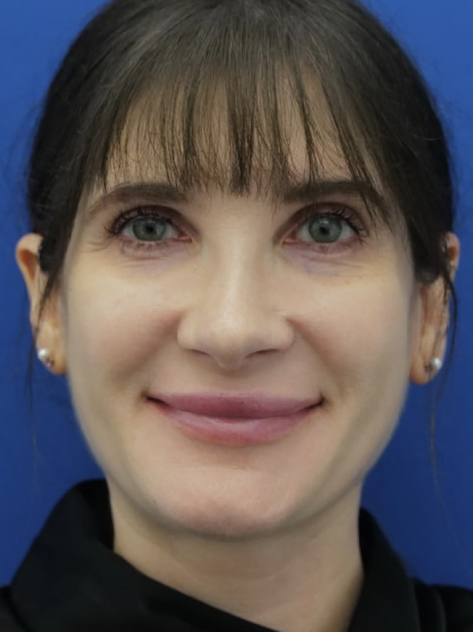 Preserving Tip Surface Aesthetics after photo. Individual results may vary.