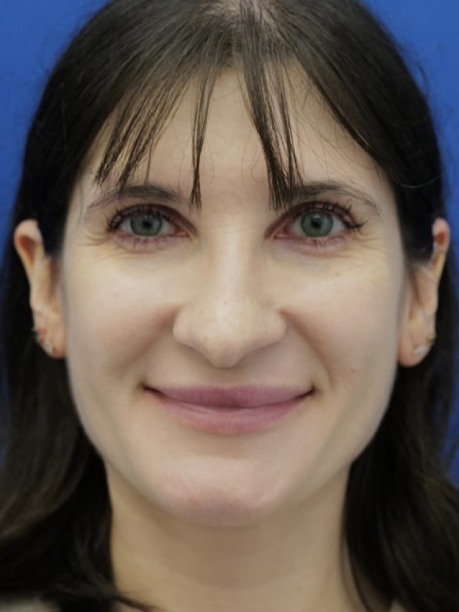 Preserving Tip Surface Aesthetics before photo. Individual results may vary.