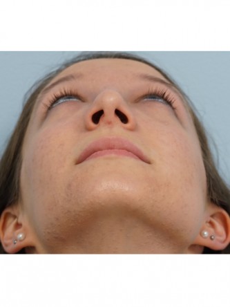 Prominent Nose Closed Rhinoplasty*