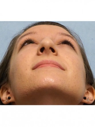 Prominent Nose Closed Rhinoplasty*