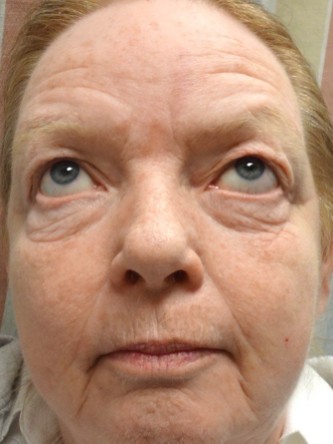 Visual Field Deficit – Eyelid Excess Skin4*