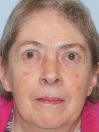 Visual Field Deficit – Eyelid Ptosis3*