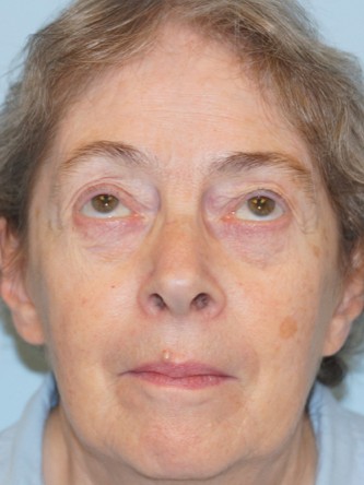 Visual Field Deficit – Eyelid Ptosis3*