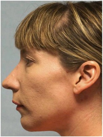 Chin Implant*