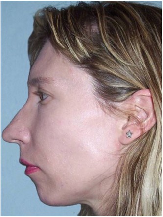 Chin Implant*