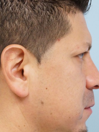 Protruding Ears – Upper Third*