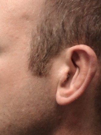 Protruding Ears – Moderate*