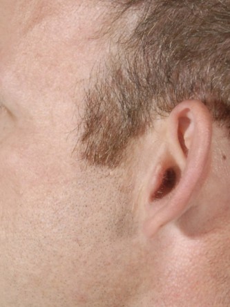 Protruding Ears – Moderate*