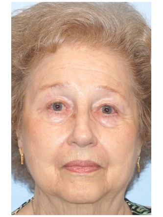 Visual Field Deficit – Eyelid Ptosis1*