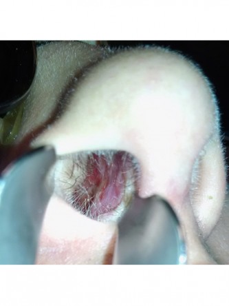 Nasal Septal Perforation3*