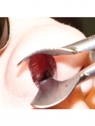 Nasal Septal Perforation3*